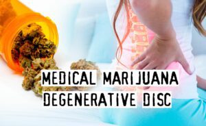 Read more about the article Medical Marijuana To Deal With Degenerative Disc Disease, Effective Or Not?